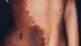 Yulianna Yussef s-a născut cu un nevus imens, care i-a acoperit o mare parte a corpului foto-01