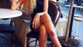 Yulianna Yussef s-a născut cu un nevus imens, care i-a acoperit o mare parte a corpului foto-04